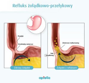 Jak rozpoznać objawy refluksu żołądka i jak dieta może pomóc?