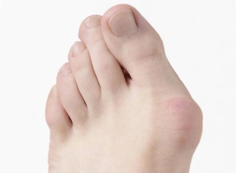 Skuteczne metody na to, jak ćwiczyć haluksy i poprawić komfort stóp