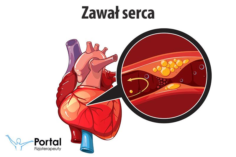 Objawy zawału serca