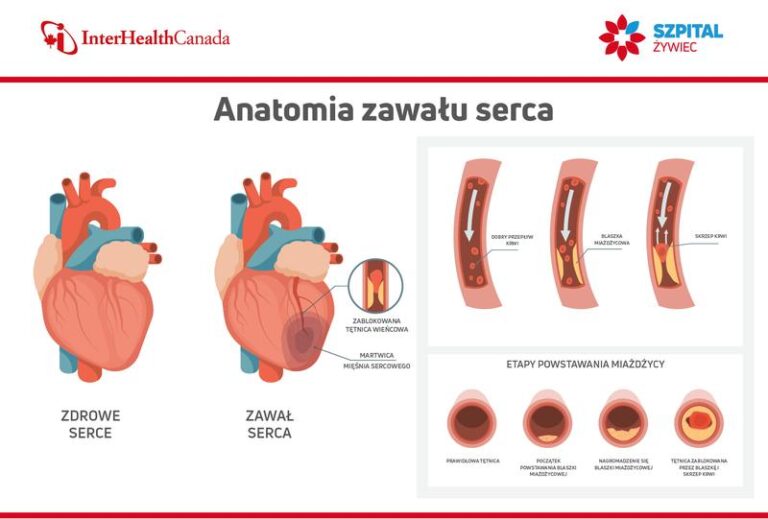 Jak długo trwa zawał mięśnia sercowego i co warto o nim wiedzieć?