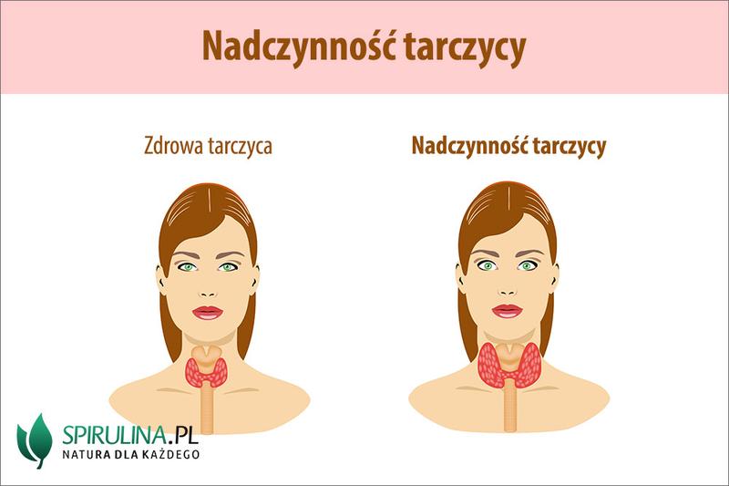 Czego unikać w diecie tarczycowej