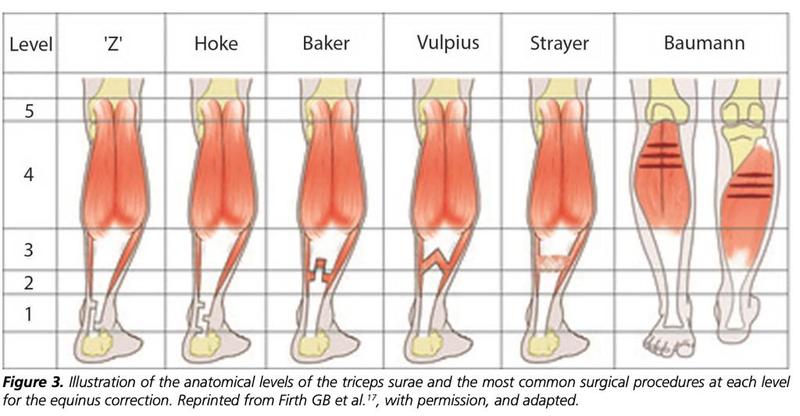 Leczenie przykurczu mięśni kręgosłupa